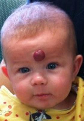 Treatment of Hemangiomas in Children | New York, NY