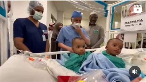 Nigerian Conjoined Twins Separated In Saudi Arabia — Gists9ja