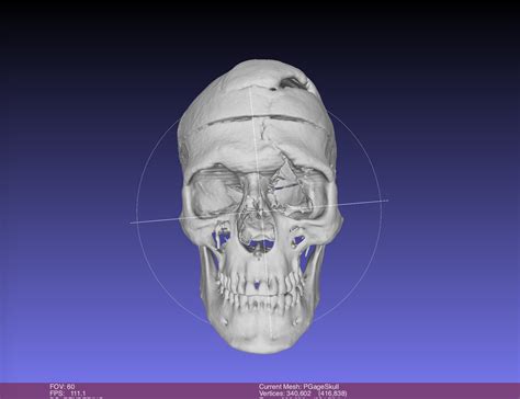 Phineas Gage Skull, harvard CT SCAN, Museum Quality High Resolution STL ...