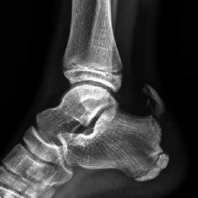 (PDF) Avulsion Fracture of Calcaneal Apophysis in an Adolescent Gymnast : A Case Report