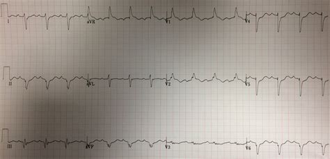 Dr. Smith's ECG Blog: Wide Complex Tachycardia and Cyanosis