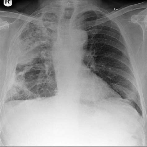 A chest radiograph showing calcified metastases from an osteogenic... | Download Scientific Diagram