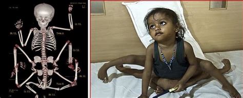 Lakshmi Tatma (Girl With 8 Limbs) ~ Bio with [ Photos | Videos ]