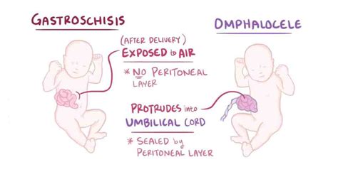 GASTROSCHISIS - www.medicoapps.org