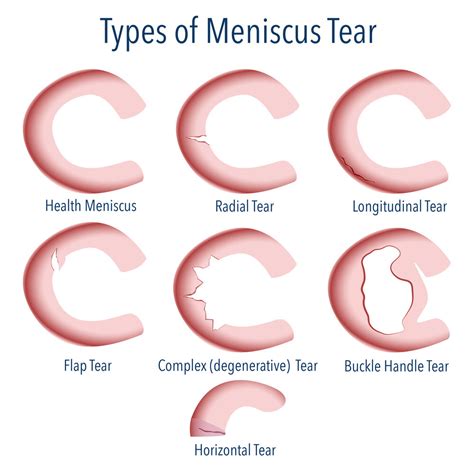 Medial Meniscus Tear