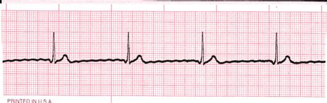 Junctional Rhythm ECG Interpretation #314