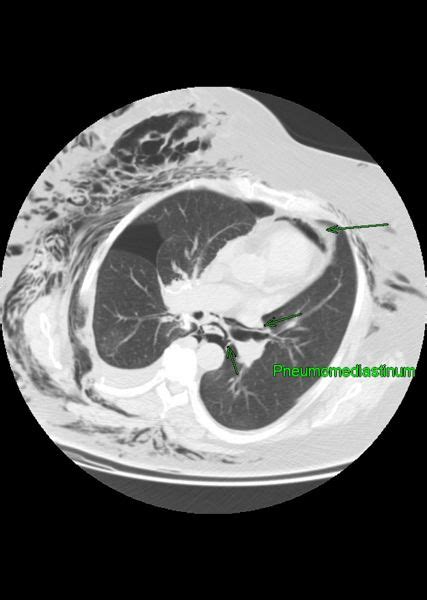 Pneumomediastinum CT - wikidoc