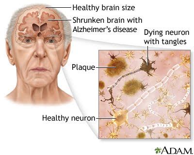 Treatment Window For Alzheimer's Disease and Related Conditions Identified