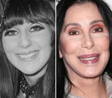 Cher before and after plastic surgery 04 – Celebrity plastic surgery online