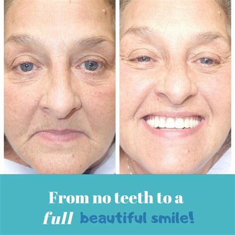 From no teeth to a full beautiful smile! - Southern Family Dental