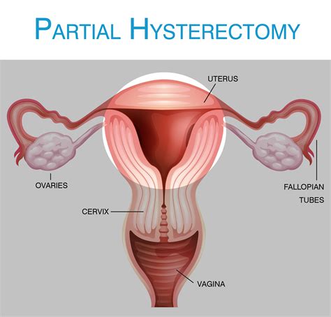 [DIAGRAM] Diagram After Hysterectomy - MYDIAGRAM.ONLINE