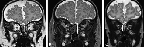 Olfactory Nerve Mri