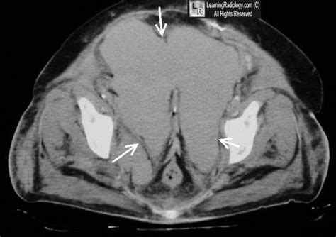 Molar tooth appearance - extravasation of contrast - extra peritoneal bladder rupture ...