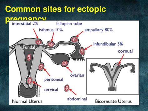 ALL ABOUT LIFE !: Ectopic Pregnancy