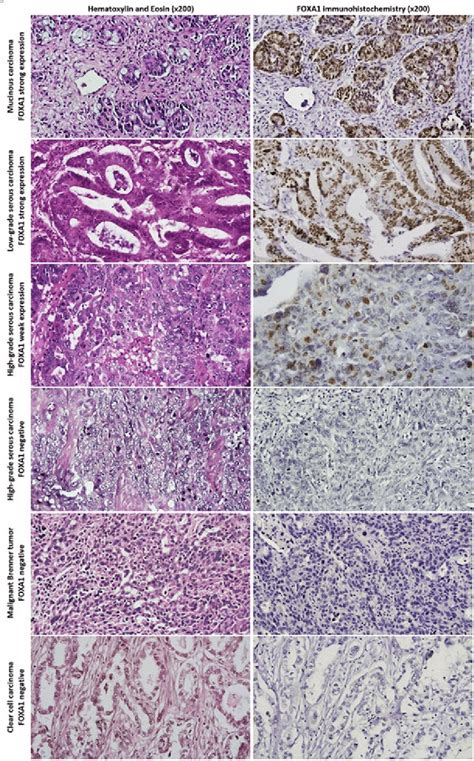 Representative examples of epithelial ovarian cancers (EOC) of... | Download Scientific Diagram