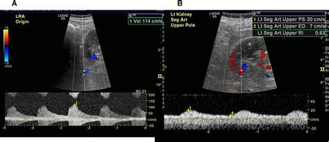 | Renal artery duplex ultrasound of the left renal artery obtained in ...