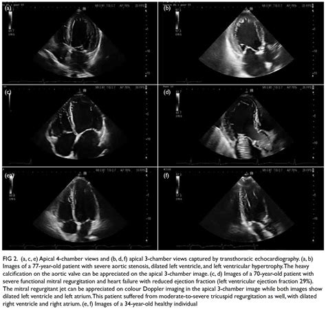 Abnormal Echocardiogram Results