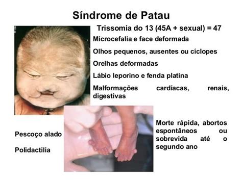 Síndrome de Patau | trissomia, causas, sintomas, tem tratamento?