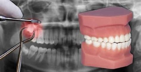 Tooth Extraction: Procedure and Guidelines