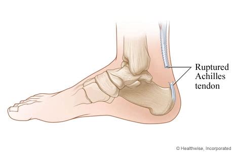 Torn Achilles Tendon | Hartford Hospital | Hartford, CT