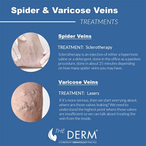 How to Treat Spider Veins for Long-Term Results