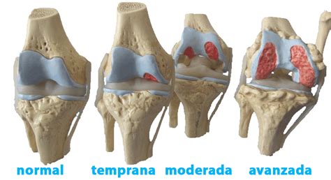 La Artrosis : Síntomas y Prevención. - MENTE & CUERPO SANO