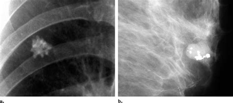 Popcorn calcification. (a) Detail from a chest radiograph shows a ...