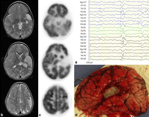 A 24-month-old girl underwent left hemispherectomy. a Preoperative EEG... | Download Scientific ...