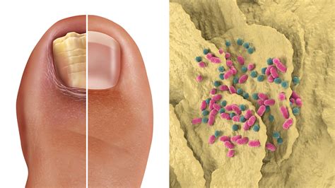 Dermatologists Explain the Causes of Fingernail Fungus (and How to Fix ...