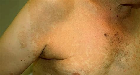 Can Fungal Infection Cause Skin Discoloration? Answered