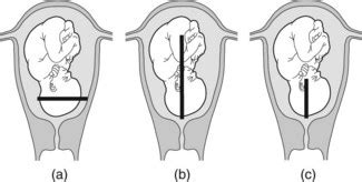 Caesarean section | Nurse Key