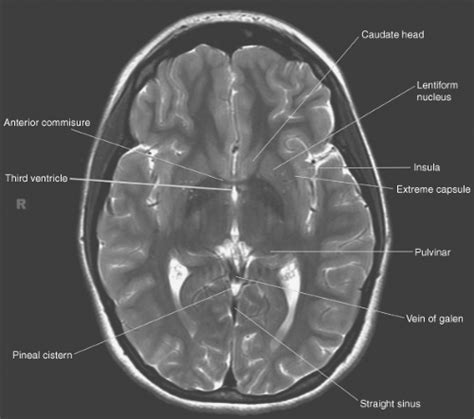 Introduction To Brain Imaging Radiology Key | Free Nude Porn Photos