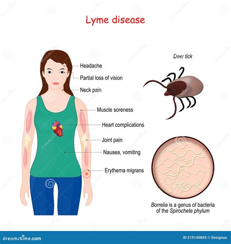 Lyme Disease. Woman With Erythema, Signs And Symptoms Lyme Borreliosis ...