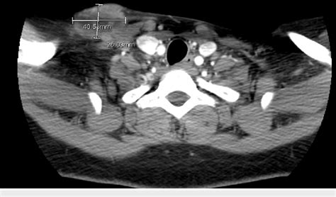 Computed tomography scan of the neck with supraclavicular mass | Download Scientific Diagram