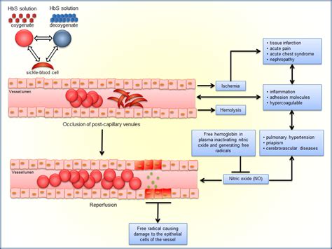 Sickle Cell Disease – Current Treatment and New Therapeutical ...