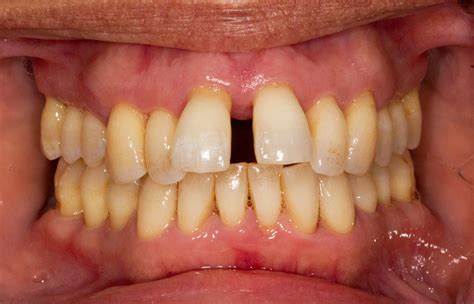 Gum disease symptoms and treatment - Cuckfield Dental