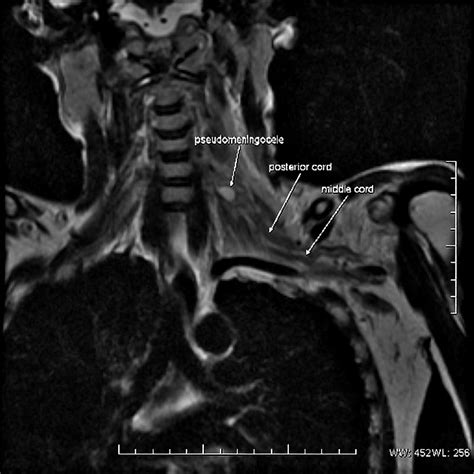 Brachial Plexus Injury Mri