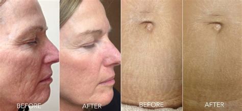 Microneedling Before & After Results | Impressions MediSpa