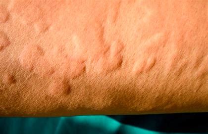 Different skin allergies – causes and treatments | Health24