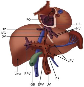 Agenesis of the Ductus Venosus | Radiology Key