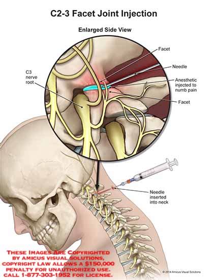 C2-3 Facet Joint Injection