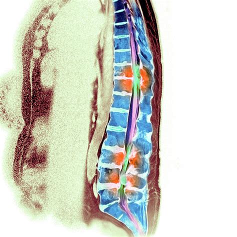 Secondary Bone Cancer Photograph by Simon Fraser/science Photo Library - Fine Art America