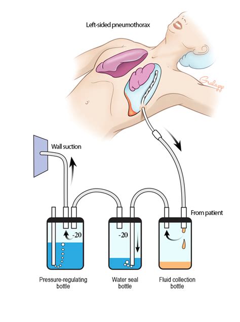 Chest Tube Complications | PSNet | Medical school essentials, Nursing school survival, Nursing ...