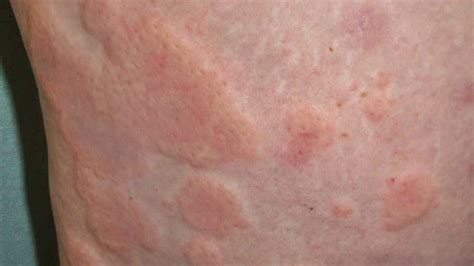 STRESS RASH - How To Identify and Treat Rashes Caused By Stress