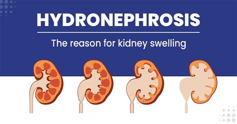 Hydronephrosis - causes, symptoms, and treatments