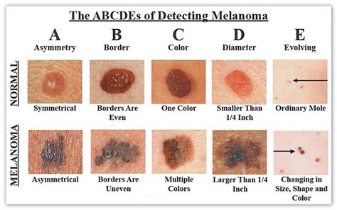 How To Check For Skin Cancer | Skin Care Network