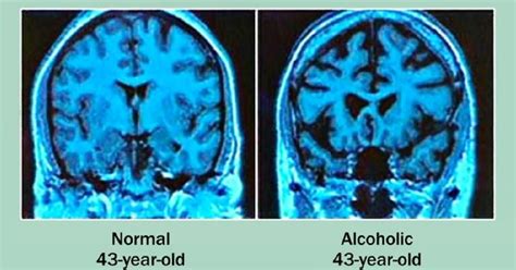 Diseased Brain Alcohol