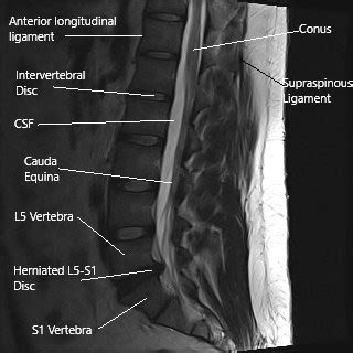 Surgical Treatment of Sciatica of Lumbar Radiculopathy | Complete Orthopedics | Multiple NY ...