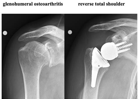 Shoulder Arthritis - University Orthopedics