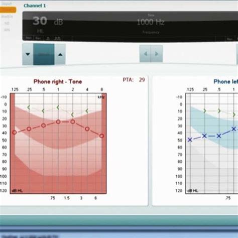 Tympanogram -bilateral B type curve, with severe Eustachian tube... | Download Scientific Diagram